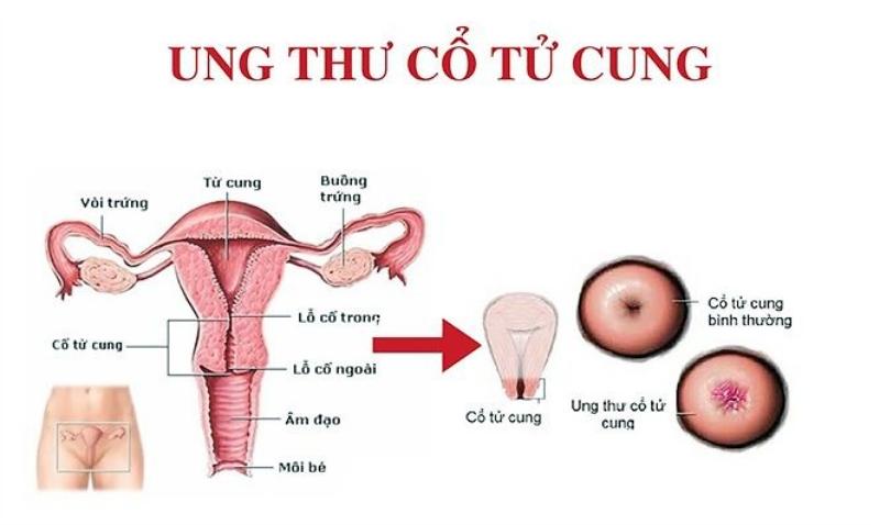 U xơ tử cung là gì? U xơ tử cung có điều trị tại nhà được không?
